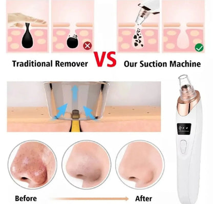 5 in 1 Rechargeable Blackhead Remover|Derma Suction