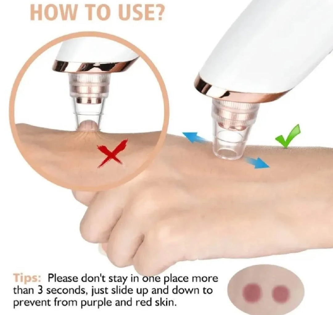 5 in 1 Rechargeable Blackhead Remover|Derma Suction